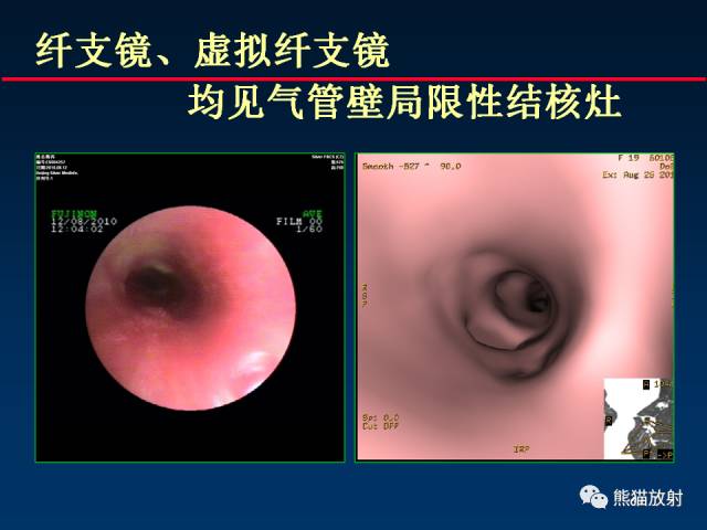 【PPT】肺结核的基础CT表现