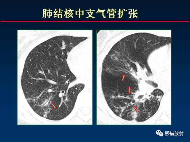 【PPT】肺结核的基础CT表现