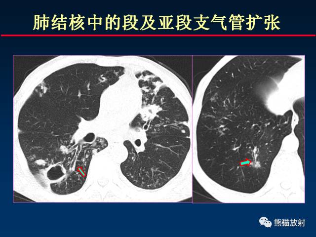 【PPT】肺结核的基础CT表现