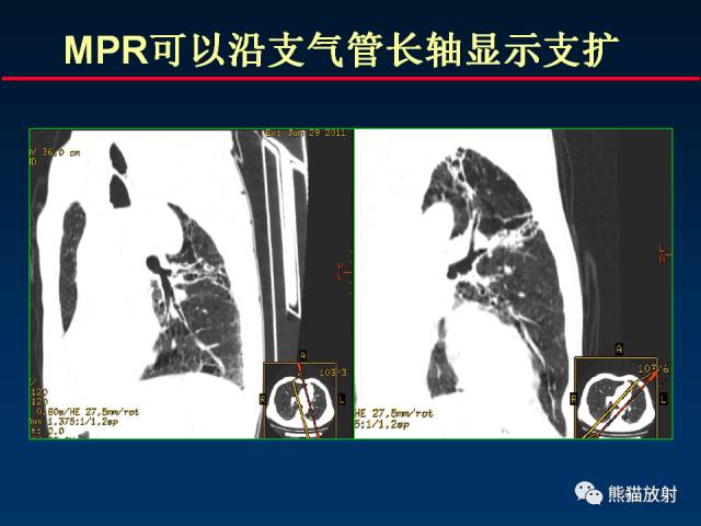 【PPT】肺结核的基础CT表现