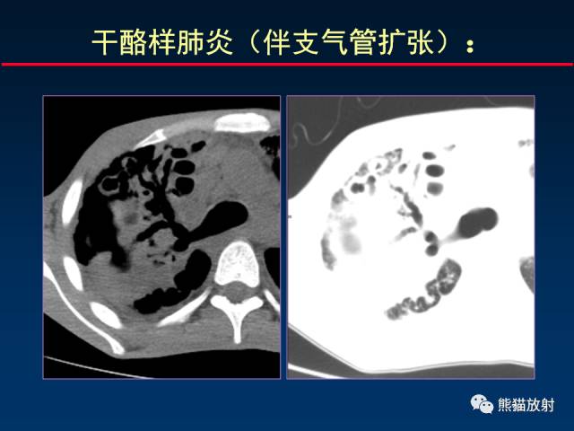 【PPT】肺结核的基础CT表现