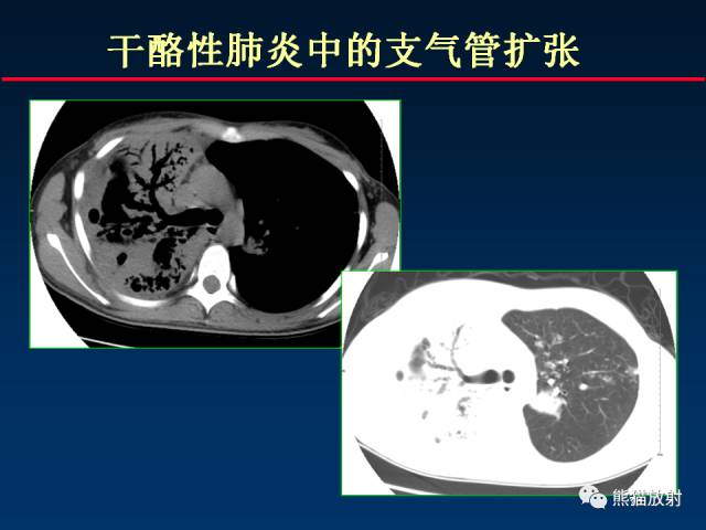 【PPT】肺结核的基础CT表现