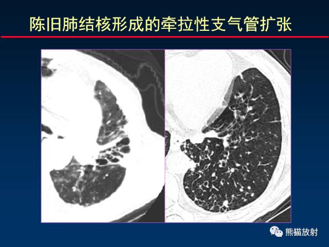 【PPT】肺结核的基础CT表现