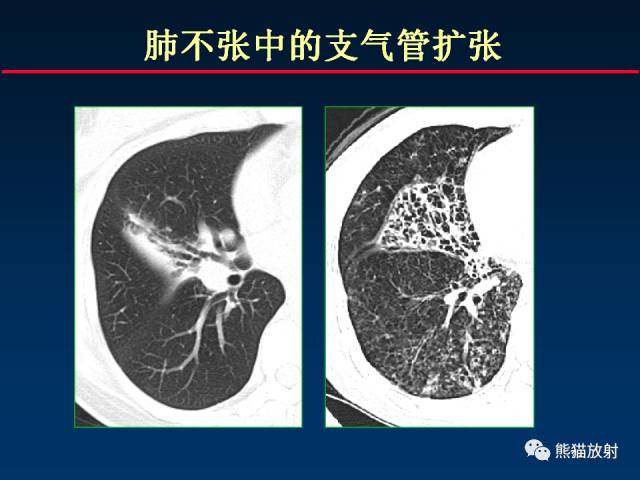 【PPT】肺结核的基础CT表现