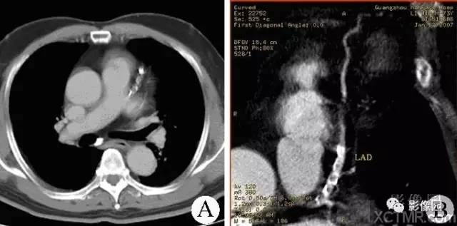 【病例】冠状动脉粥样硬化性心脏病1例CT 【病例】冠状动脉粥样硬化性心脏病1例CT