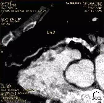 【病例】冠状动脉粥样硬化性心脏病1例CT