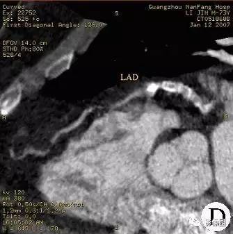 【病例】冠状动脉粥样硬化性心脏病1例CT 【病例】冠状动脉粥样硬化性心脏病1例CT