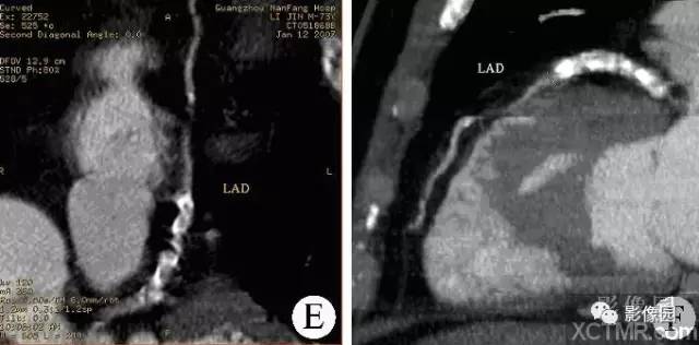 【病例】冠状动脉粥样硬化性心脏病1例CT 【病例】冠状动脉粥样硬化性心脏病1例CT