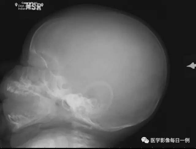 【病例】头皮血肿(骨膜下血肿)1例CT 【病例】头皮血肿(骨膜下血肿)1例CT