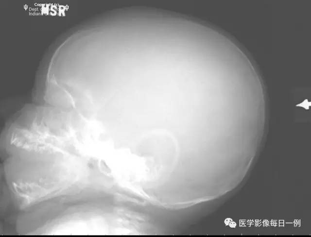 【病例】头皮血肿(骨膜下血肿)1例CT 【病例】头皮血肿(骨膜下血肿)1例CT