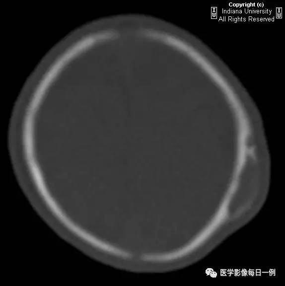 【病例】头皮血肿(骨膜下血肿)1例CT