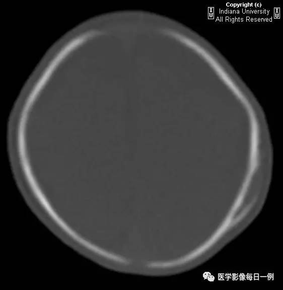 【病例】头皮血肿(骨膜下血肿)1例CT 【病例】头皮血肿(骨膜下血肿)1例CT