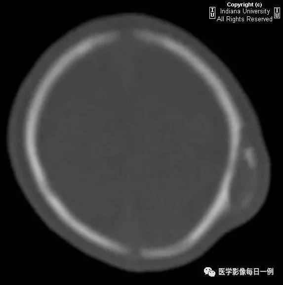 【病例】头皮血肿(骨膜下血肿)1例CT 【病例】头皮血肿(骨膜下血肿)1例CT