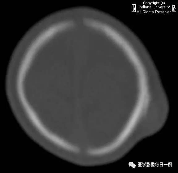 【病例】头皮血肿(骨膜下血肿)1例CT 【病例】头皮血肿(骨膜下血肿)1例CT