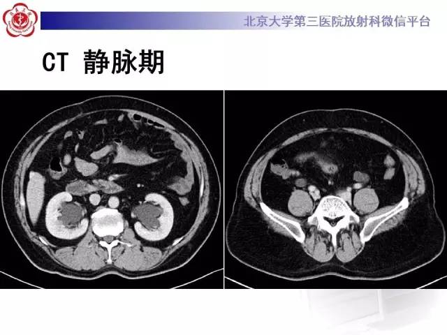 【病例】盆腔脂肪增多症1例CT及MR