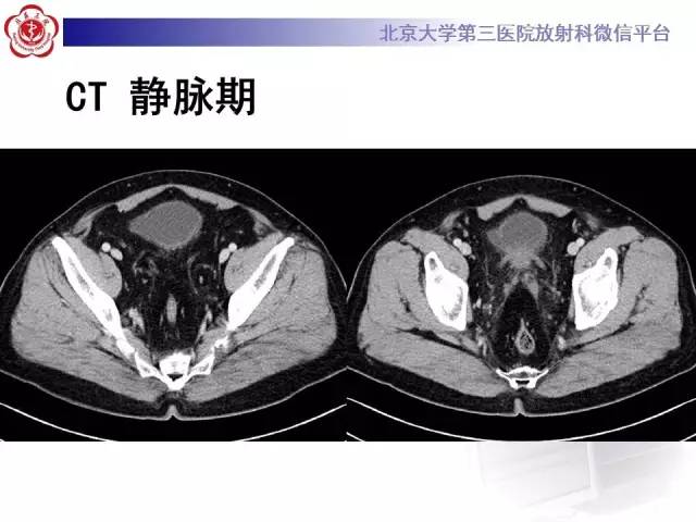 【病例】盆腔脂肪增多症1例CT及MR