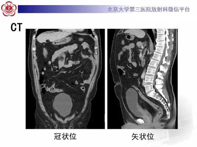 【病例】盆腔脂肪增多症1例CT及MR