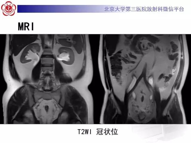【病例】盆腔脂肪增多症1例CT及MR