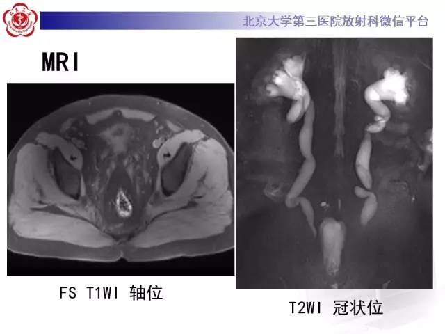 【病例】盆腔脂肪增多症1例CT及MR