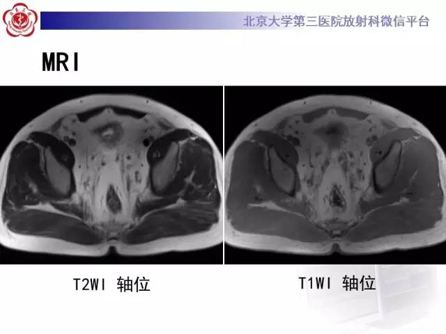 【病例】盆腔脂肪增多症1例CT及MR
