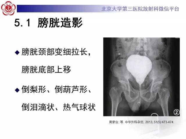 【病例】盆腔脂肪增多症1例CT及MR