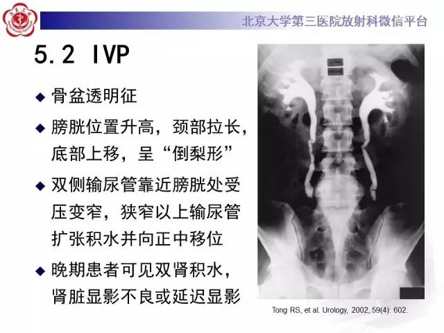 【病例】盆腔脂肪增多症1例CT及MR