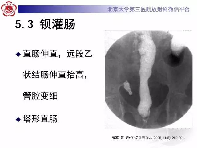 【病例】盆腔脂肪增多症1例CT及MR