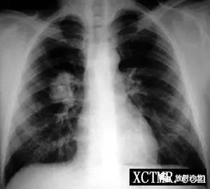 【病例】肺错构瘤1例CT