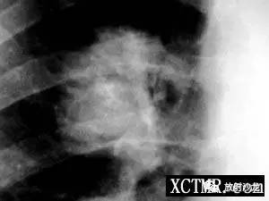 【病例】肺错构瘤1例CT