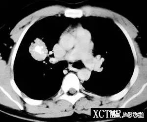 【病例】肺错构瘤1例CT