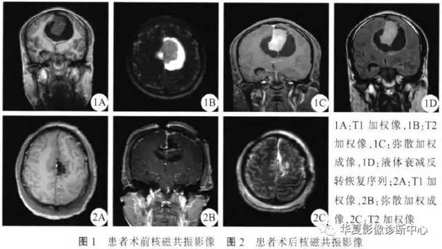 与众不同的脑膜瘤——囊性脑膜瘤