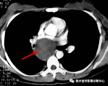 在纵膈内看到囊性占位，要想到这10种病