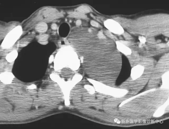 在纵膈内看到囊性占位，要想到这10种病