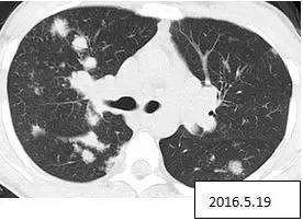 【病例】两肺多发结节,激素治疗后消失——肺结节病1例 【病例】两肺多发结节,激素治疗后消失——肺结节病1例