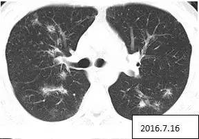 【病例】两肺多发结节,激素治疗后消失——肺结节病1例 【病例】两肺多发结节,激素治疗后消失——肺结节病1例