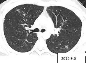 【病例】两肺多发结节,激素治疗后消失——肺结节病1例 【病例】两肺多发结节,激素治疗后消失——肺结节病1例