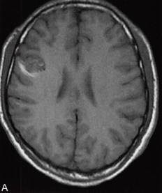 【病例】脑实质内室管膜瘤1例MR影像表现 【病例】脑实质内室管膜瘤1例MR影像表现