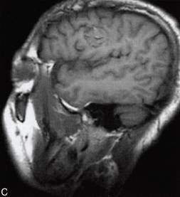 【病例】脑实质内室管膜瘤1例MR影像表现 【病例】脑实质内室管膜瘤1例MR影像表现