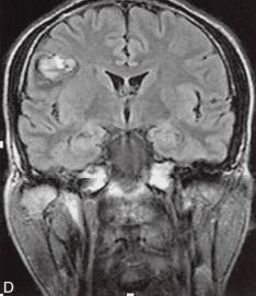 【病例】脑实质内室管膜瘤1例MR影像表现 【病例】脑实质内室管膜瘤1例MR影像表现