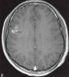 【病例】脑实质内室管膜瘤1例MR影像表现 【病例】脑实质内室管膜瘤1例MR影像表现