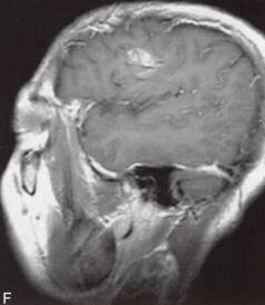 【病例】脑实质内室管膜瘤1例MR影像表现 【病例】脑实质内室管膜瘤1例MR影像表现