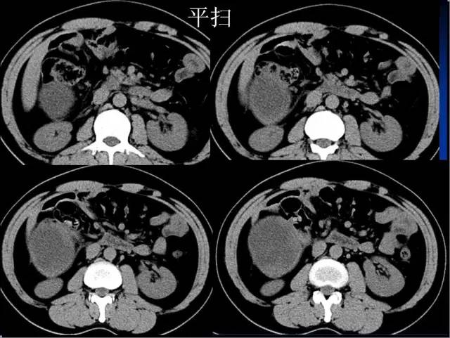 【病例】腹腔内隐睾精原细胞瘤1例CT影像表现 【病例】腹腔内隐睾精原细胞瘤1例CT影像表现