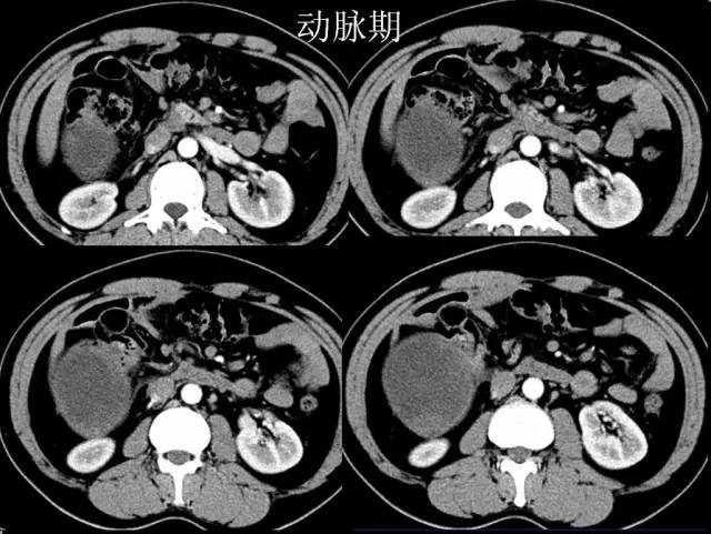 【病例】腹腔内隐睾精原细胞瘤1例CT影像表现 【病例】腹腔内隐睾精原细胞瘤1例CT影像表现