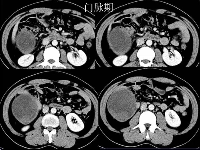 【病例】腹腔内隐睾精原细胞瘤1例CT影像表现 【病例】腹腔内隐睾精原细胞瘤1例CT影像表现