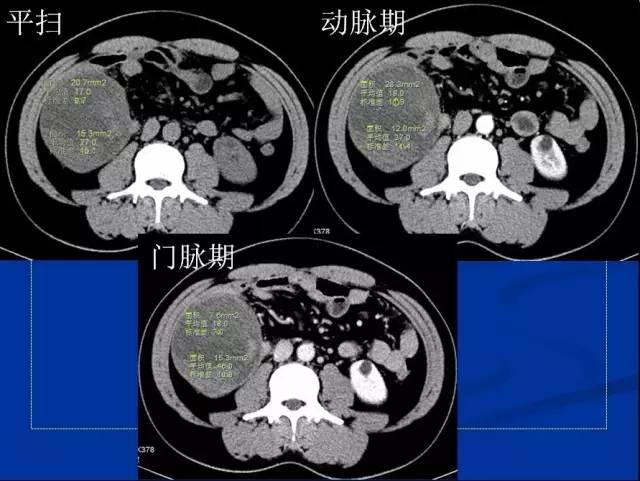 【病例】腹腔内隐睾精原细胞瘤1例CT影像表现 【病例】腹腔内隐睾精原细胞瘤1例CT影像表现