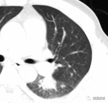 【病例】与肺门及胸膜关系比较密切的肺结核4例CT