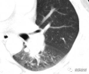 【病例】与肺门及胸膜关系比较密切的肺结核4例CT