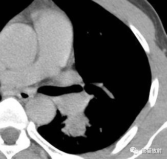 【病例】与肺门及胸膜关系比较密切的肺结核4例CT