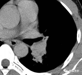 【病例】与肺门及胸膜关系比较密切的肺结核4例CT