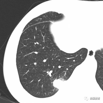【病例】与肺门及胸膜关系比较密切的肺结核4例CT